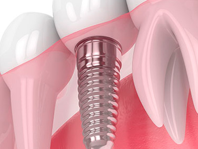 Implantes Dentários