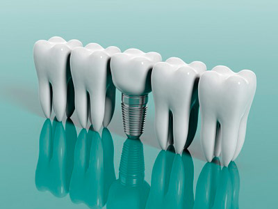Clínica de Implantes Dentários - Paracambi - RJ